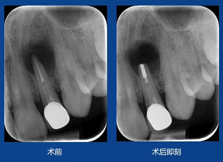 冯瑞明先生案例-根尖屏障术