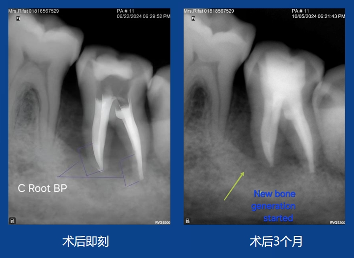 Sazzad Ur Rahman 先生案例——根吸收修复及充填